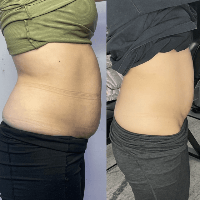 CryoLean360 at DFW Microblading in Fort Worth, TX